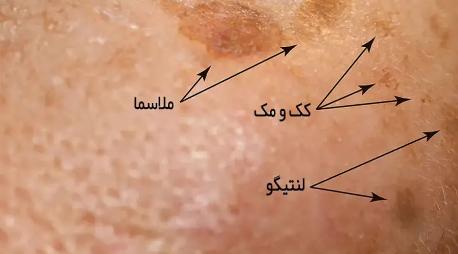 برای خرید روغن رفع لک های پوست بدن با دکتر اویل تماس بگیرید