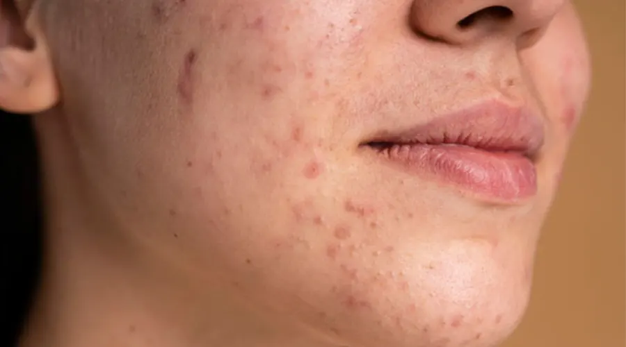 بهترین قیمت خرید روغن رفع جای جوش و آکنه 