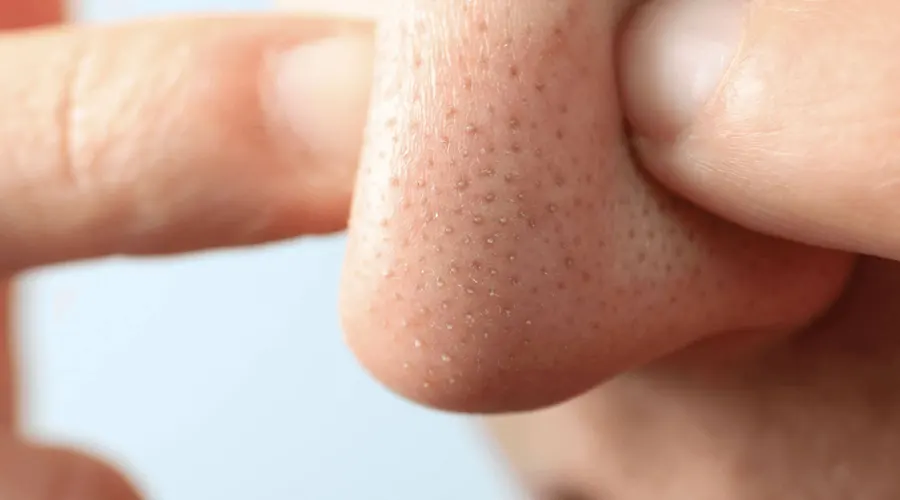 برای نتیجه بهتر در استفاده از روغن مخصوص جوش های سرسیاه باید چه نکاتی را رعایت کنیم