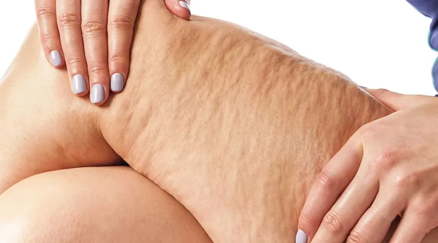 چگونهاز روغن ترکیبی رفع سلولیت برای از بین بردن آن استفاده کنیم