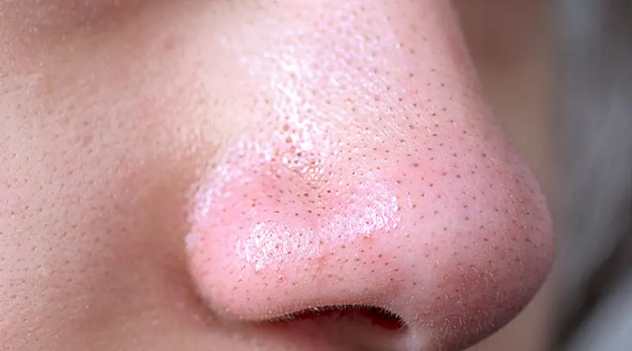 نحوه استفاده از روغن مخصوص جوش های سرسیاه چگونه است