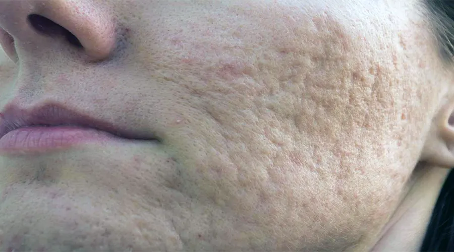 خرید صابون رفع جای جوش و آکنه دکتر اویل