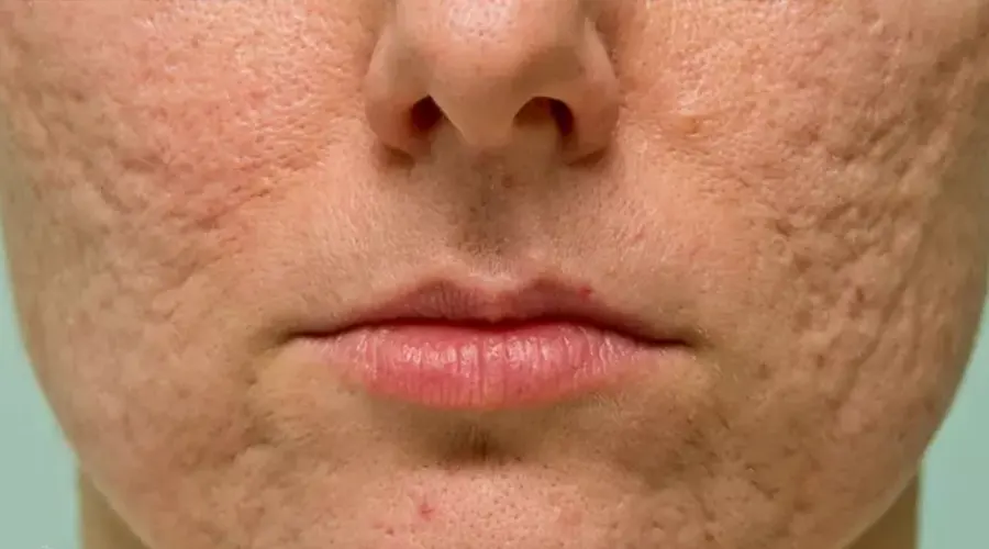 بهترین روش مصرف صابون رفع جای جوش و آکنه دکتر اویل