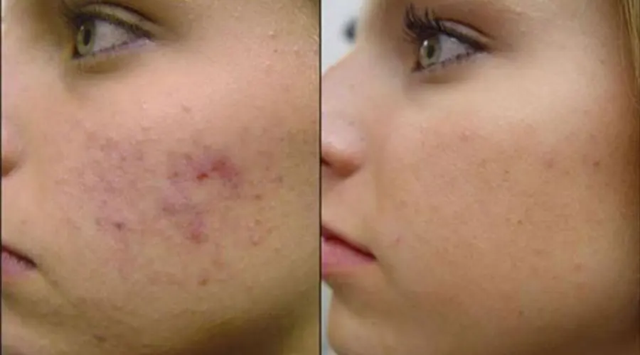 مناسب ترین قیمت صابون رفع جای جوش و آکنه دکتر اویل