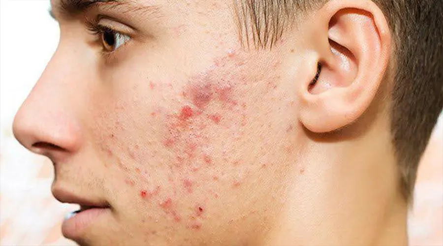 بهترین مارک صابون رفع جای جوش و آکنه