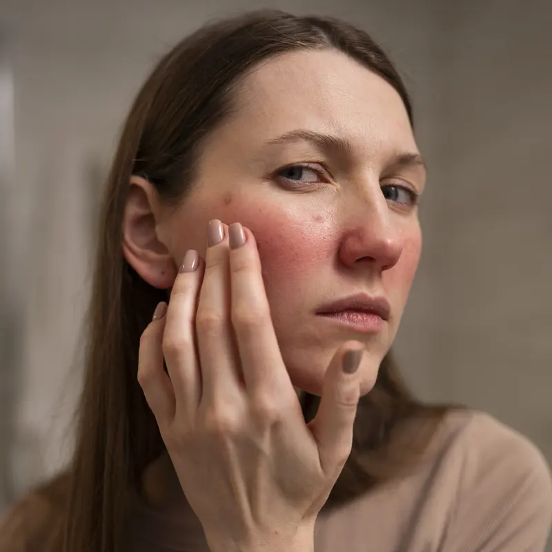 از بین بردن لک صورت ناشی از آفتاب سوختگی